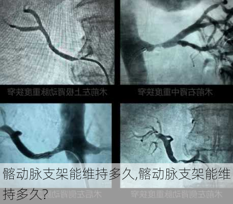 髂动脉支架能维持多久,髂动脉支架能维持多久?